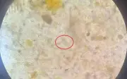Người đàn ông đau dạ dày kéo dài bất ngờ phát hiện nhiễm sán lá gan do ăn cá sống