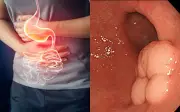Người đàn ông bất ngờ phát hiện ung thư dạ dày từ dấu hiệu nhiều người bỏ qua