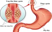 Người đàn ông khỏe mạnh phát hiện ung thư thực quản: 2 sai lầm nhiều người Việt mắc