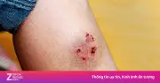 Người phụ nữ 68 tuổi tử vong vì bệnh dại sau 3 tháng bị chó cắn