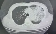 Nguy cơ viêm phổi nặng do vi khuẩn Legionella từ điều hòa không vệ sinh