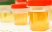 Niệu liệu pháp: Trào lưu chữa bệnh bằng nước tiểu tái xuất giữa thời hiện đại