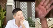 NSND Chí Trung mắc bệnh giun đũa chó mèo: Triệu chứng và cách phòng ngừa