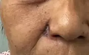 Nốt ruồi trên mũi hóa ung thư, phá hủy gần toàn bộ cánh mũi
