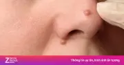 Phát hiện ung thư da từ nốt ruồi nhỏ trên mặt