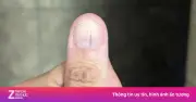Phát hiện ung thư hắc tố từ vệt đen ở móng tay sau 6 năm chủ quan