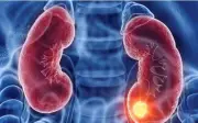 Phát hiện ung thư thận giai đoạn sớm nhờ dấu hiệu nhiều người bỏ qua