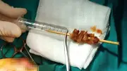 Que xiên thịt nướng đâm sâu vào mắt trẻ: Ca phẫu thuật hy hữu