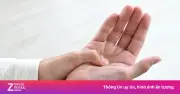 Tê tay kéo dài cảnh báo đột quỵ: Dấu hiệu nhận biết và cách xử trí