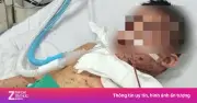 Từ vài nốt đỏ trên da, bé trai 6 tuổi nguy kịch sau 12 giờ vì thủy đậu biến chứng