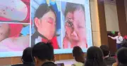 Thủy đậu lây từ trước khi nổi ban, chuyên gia khuyến cáo tiêm đủ 2 mũi vắc xin