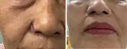 Tái tạo cánh mũi cho bệnh nhân ung thư da bằng kỹ thuật vạt da tại chỗ