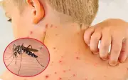 TP.HCM cảnh báo dịch sốt xuất huyết và tay chân miệng gia tăng mạnh