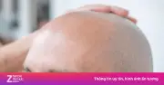 Tây Ban Nha dẫn đầu thế giới về tỷ lệ nam giới hói đầu, châu Á thấp nhất