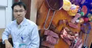 Ung thư đại tràng ngày càng trẻ hóa: Nguyên nhân và cách phòng ngừa