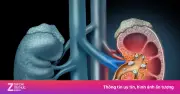 Vợ bác sĩ, chồng dược sĩ đi khám phát hiện cả hai thận ứ nước nặng