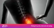 Vì sao dân văn phòng dễ thoát vị đĩa đệm dù không lao động nặng?
