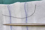 Va phải cây chổi, người phụ nữ nguy kịch vì cọng kẽm 18cm xuyên ngực