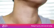 Vòng cổ to bất thường cảnh báo nhiều bệnh nguy hiểm, cần đi khám ngay