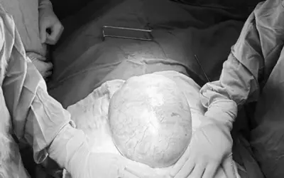 Bé gái 16 tuổi mang hai khối u buồng trứng nặng gần 15kg được phẫu thuật thành công