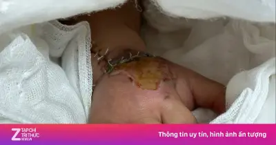 Báo động đỏ cứu bàn tay đứt lìa cho bé 2 tuổi bị máy dập nắp cốc