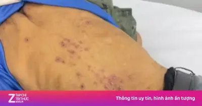 Cụ ông 77 tuổi nhiễm cùng lúc sán lá gan và giun lươn