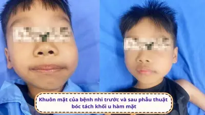 Cứu bé gái 12 tuổi bị u răng khổng lồ 6x7cm biến dạng khuôn mặt