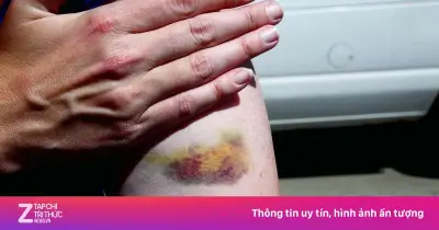 Dấu hiệu xơ gan giai đoạn đầu dễ bỏ qua: Mệt mỏi, sụt cân, ngứa da