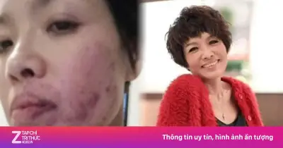 Nữ diễn viên Bảo Bội Như bị tát bầm mặt vì cảnh quay thật