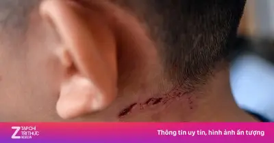Người đàn ông ở Nghệ An tử vong nghi do bệnh dại sau 5 tháng bị chó nhà cắn