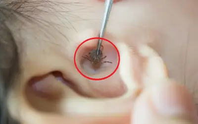 Phát hiện bọ chét ký sinh trong tai bé gái 2 tuổi ở Sơn La