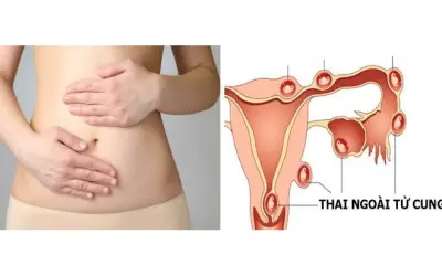 Tưởng rong kinh, người phụ nữ suýt mất mạng vì vỡ thai ngoài tử cung