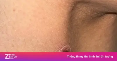 Vết đốt khô không đau ở khoeo chân cảnh báo sốt mò suy đa tạng