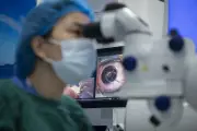 10 giây laser xóa cận 9 đi-ốp, chính xác từng micromet