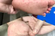 10 trẻ tử vong do tay chân miệng: 3 dấu hiệu cảnh báo bệnh chuyển nặng