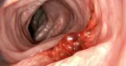3 thói quen hàng ngày làm tăng nguy cơ ung thư đại trực tràng ở người Việt