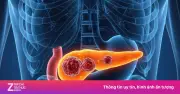 4 dấu hiệu âm thầm cảnh báo sớm ung thư tuyến tụy sau bữa ăn