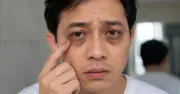 5 dấu hiệu ở mắt cảnh báo gan nhiễm mỡ, đừng bỏ qua