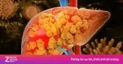 Ai có nguy cơ mắc bệnh gan cao? Cần đi khám sớm và thường xuyên