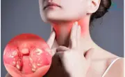 Đau họng kéo dài 3 tuần, người đàn ông 60 tuổi phát hiện ung thư amidan giai đoạn 4