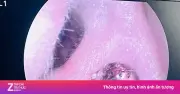 Đau tai kéo dài, người phụ nữ phát hiện ve chó ký sinh trong ống tai