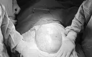 Bé gái 16 tuổi mang hai khối u buồng trứng nặng gần 15kg được phẫu thuật thành công
