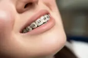 Bí ẩn tiến hóa đằng sau việc ngày càng nhiều người phải niềng răng