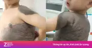 Bé trai 7 tuổi mang 'mai rùa' trên lưng: Hành trình 6 lần đại phẫu