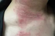 Bác sĩ Bệnh viện Bạch Mai hướng dẫn 2 bước xử lý viêm da do kiến ba khoang