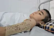 Bạn đọc Dân trí ủng hộ hơn 375 triệu đồng cứu cậu bé bỏng điện 56%