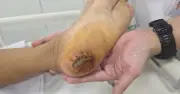 Bệnh viện Bạch Mai cảnh báo: Nhiều ca uốn ván nặng do chủ quan vết thương nhỏ