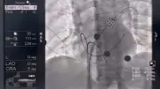 Bệnh viện Bạch Mai triển khai công nghệ PFA điều trị rung nhĩ tiên tiến
