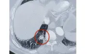 Bất ngờ: Khối u trong phổi hóa ra là đầu ớt 0,5 cm