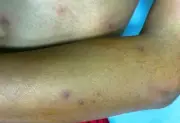 Cà Mau: Cứu sống bé trai bị ong vò vẽ đốt gây sốc phản vệ nặng